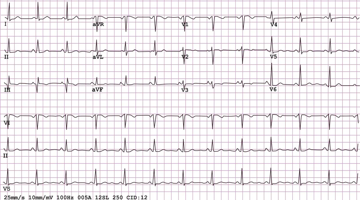 A 12-lead electrocardiogram printout showing heart rhythm traces on grid paper